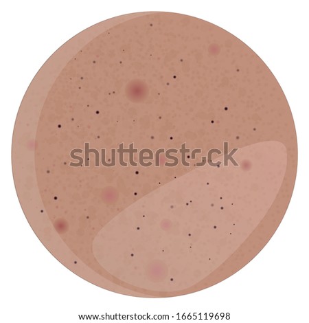 Oily skin with pimples, black dots and greasy Shine. Suitable for dermatology, medicine and cosmetology. Vector illustration on a separate background.