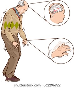 Old Man With Parkinson Symptoms Difficult Walking