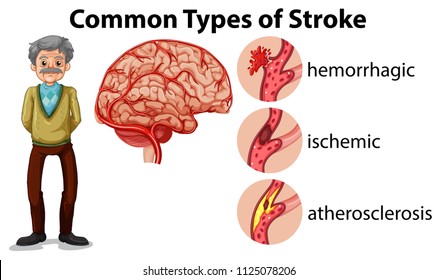 And Old Man and Types of Stroke illustration