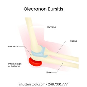 Olecranon Bursitis Inflammation of Bursa