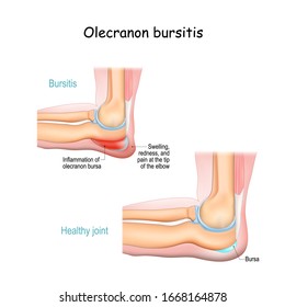 Olecranon bursitis. student elbow. medical condition. inflammation of the bursa located under the elbow Olecranon. trauma or repetitive smaller traumas. Vector illustration for medical use