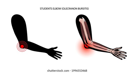Olecranon joint bursitis. Inflamed bursa. Student elbow disease, pain and deformity in the human arms. Diagnosis, treatment and injection concept. Anatomical poster, flat medical vector illustration.