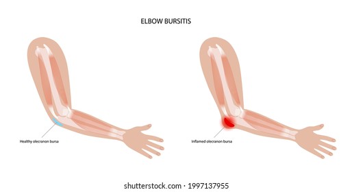 Olecranon joint bursitis. Inflamed bursa. Student elbow disease, pain and deformity in the human arms. Diagnosis, treatment and injection concept. Anatomical poster, flat medical vector illustration.