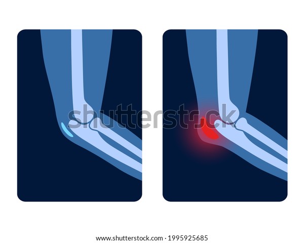 Olecranon Joint Bursitis Inflamed Bursa Student Stock Vector (Royalty ...