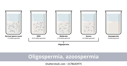 Oligospermia Azoospermia Visualization Sperm Count That Stock Vector ...