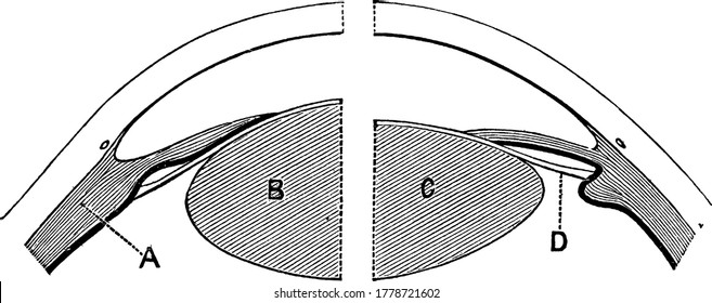 A la derecha la lente está dispuesta para visión distante, el músculo ciliar está relajado, y el ligamento, 'D' es tenso, tan aplastante por su compresión el frente de la lente 'C', a la izquierda el músculo