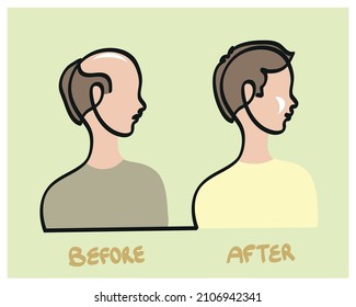 One line drawing of scared man before and after transplant hair. 
One continuous line drawing of man before and after hair loss.