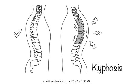 Una de las deformidades espinales más comunes, en la que la cresta espinal tiene una forma arqueada excesivamente convexa dirigida hacia atrás. Columna sana y columna vertebral con cifosis. Vector aislado.