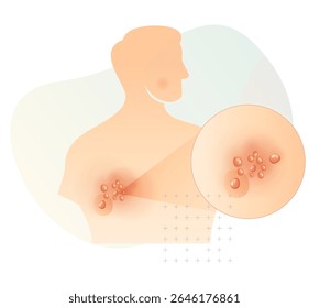 One Side Rashes on the Back - Herpes zoster - Shingles - Stock Illustration as EPS 10 File