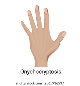 Onychocryptosis on the hand vector illustration.