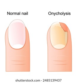 Onycholysis. Comparison and difference between a healthy fingernail and detachment of the nail plate from the nail bed. Nail health. Vector illustration