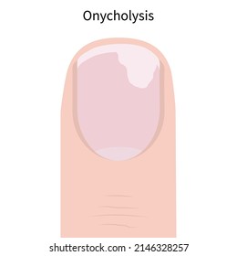 Onycholysis. Nail diseases. Complications after using gel polish. Vector illustration