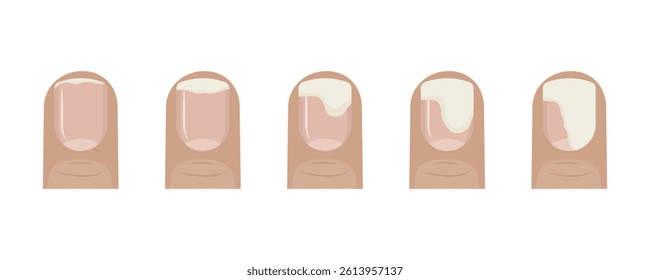 Onycholysis stages showing nail separating from nail bed
