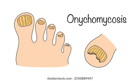 Onychomycosis. A chronic infectious disease caused by exposure to pathogenic fungal microorganisms. Color illustration showing nail fungus. Cosmetic and medical problem. Vector illustration.