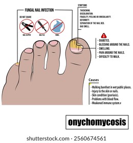 Onychomycosis, fungal infection of the nail plate. Toenail fungus.