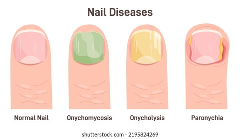 Onychomycosis, onycholysis, paronychia. Nail diseases, nail fungal infection. Injured yellow human fingernail. Flat vector illustration