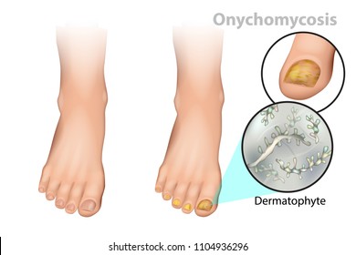 Onychomycosis or tinea unguium. Fungal nail infection. Dermatophyte