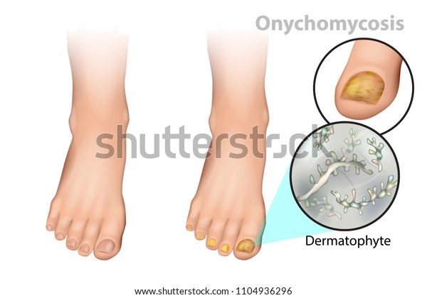 Onychomycosis Tinea Unguium Fungal Nail Infection Stock Vector (Royalty ...