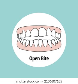 Open Bite. Dental problem vector illustration. Dental care concept.