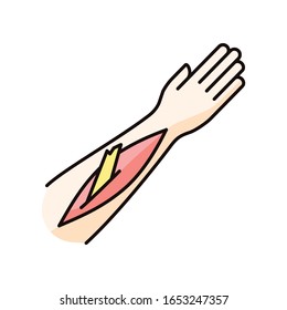 Open bone fracture RGB color icon. Bone sticking out of human arm. Badly injured hand. Wounded limb. Accident. Emergency. Healthcare. Isolated vector illustration