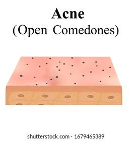 Open comedones. Acne on the skin. Dermatological and cosmetic diseases on the skin of the face acne. Infographics. Vector illustration on isolated background.