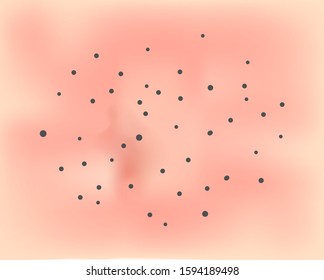 Open comedos. Skin with acne background. Black spots. Acne on the skin texture. Infographics. Vector illustration.