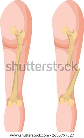 An open fracture is when a broken bone pierces through the skin, exposing the bone and increasing the risk of infection. A closed fracture does not penetrate the skin