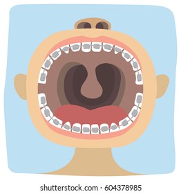 Open mouth of baby and braces on teeth