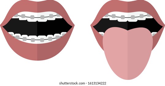 Open mouth with braces and tongue sticking out. Vector image. Flat design