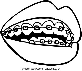 Open mouth with brackets. Dental  care for perfect white teeth and smile. Isolated black and white vector illustration.