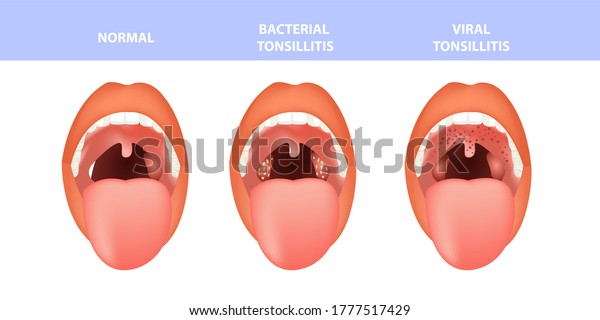 Open Mouth Normal Tonsillitis Bacterial Viral Stock Vector (Royalty ...