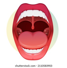 Open Mouth with Sore Throat and Tonsillitis  - stock illustration as EPS 10 File