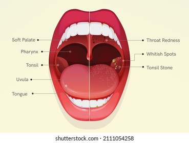 Open Mouth mit Sore Throat und Tonsillitis - Stockillustration als EPS10-Datei