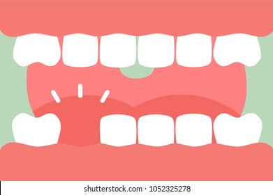 an open mouth with strong teeth and tongue and missing tooth - dental cartoon vector flat style cute character for design