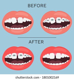 Abrir boca, dientes con corrección de la llave antes y después de la ilustración del vector.