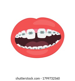 Open mouth with teeth braces isolated on white background vector illustration.