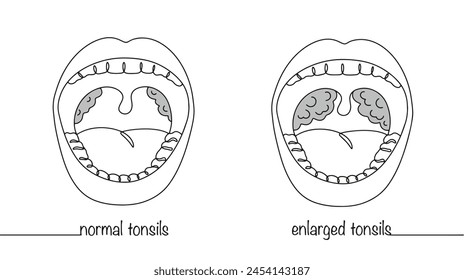 Open mouth with visible tonsils. Normal and inflamed human tonsils. Simple line illustration. Isolated vector on white background.