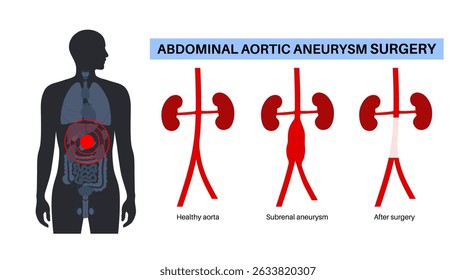 Open surgery for abdominal aortic aneurysm. Abdominal incision where the abdominal aorta is exposed. A synthetic graft is placed to replace the weakened aortic segment medical flat vector illustration