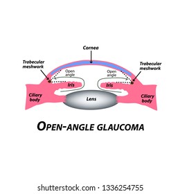 Open-angle glaucoma. A common type of glaucoma. The anatomical structure of the eye. Infographics. Vector illustration on isolated background.