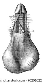 Operation of hypospadias (Process for Th Anger), vintage engraved illustration.  Usual Medicine Dictionary by Dr Labarthe - 1885