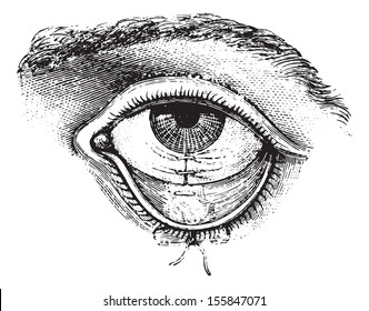 Operation of Symblepharon. Suture of the conjunctiva, vintage engraved illustration. Usual Medicine Dictionary by Dr Labarthe - 1885.