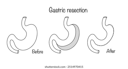 Uma operação na qual uma grande parte do estômago é removida, após a qual a continuidade do trato digestivo é restaurada. Reduzir o tamanho do estômago por razões médicas. Operação médica.