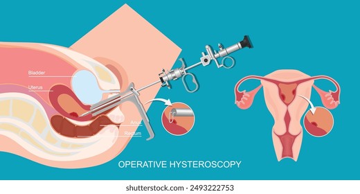 Operative hysteroscopy is a minimally invasive gynecological procedure in which an endoscopic optical lens is inserted through the cervix,vector illustration.