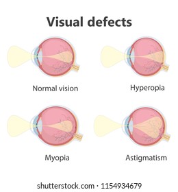 Ophthalmic concept, eye defects. Normal vision, Hyperopia, Myopia. Vector illustration.