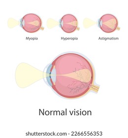 Ophthalmic concept, eye defects. Normal vision, Hyperopia, Myopia.