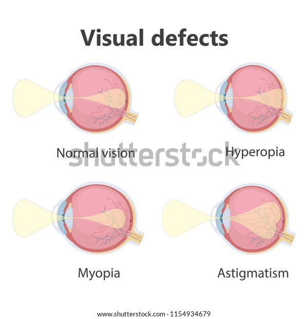 Ophthalmic Concept Eye Defects Normal Vision Stock Vector (Royalty Free ...