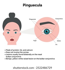 Oftalmologia. Informações pinguéculas e infográficas 