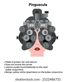 Oftalmologia. Informações pinguéculas e infográficas 