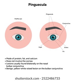 Oftalmologia. Informações pinguéculas e infográficas 