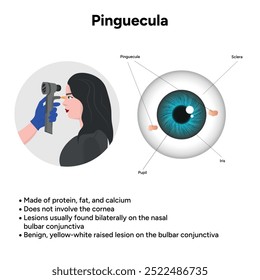 Ophthalmology. Pinguecula information and infographic 